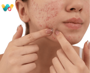 Acne / Pimple