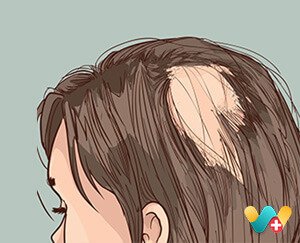 Alopecia Areata