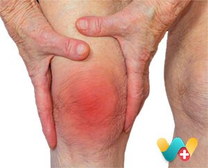 Arthritis