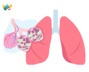 Bronchiectasis