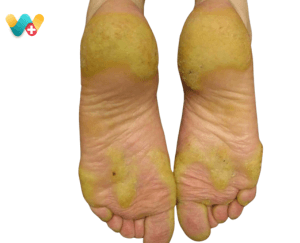 Callosities (corns)