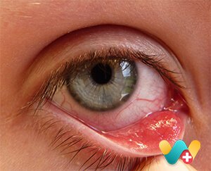 Chalazion