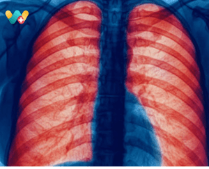 Chronic Obstructive Pulmonary Disease (COPD)