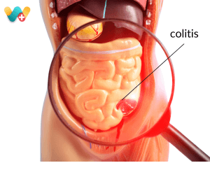 Colitis