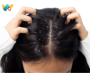 Dandruff