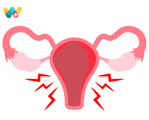Endometriosis