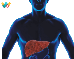 Fatty Liver