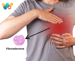 Fibroadenoma 