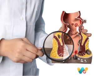 Fistula
