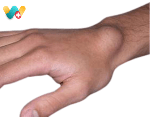 Ganglion