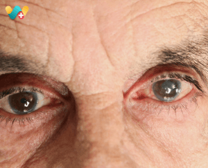 Glaucoma