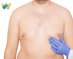 Gynecomastia