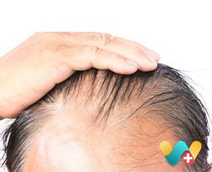 Hair Fall