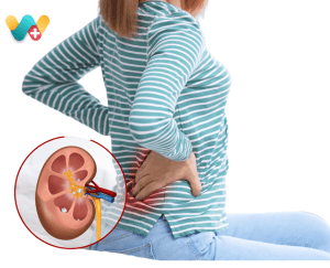 kidney Stones
