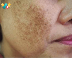 melasma