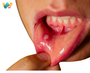 Mouth Ulcers
