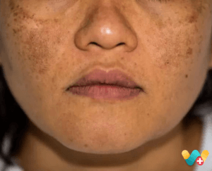 Pigmentation - झाइंया