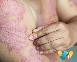 Psoriasis