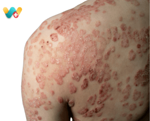 Skin Psoriasis