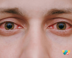 Redness in Eyes 