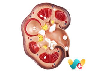 Renal Stone