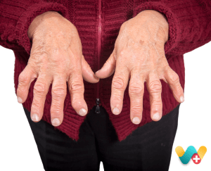 Rheumatoid Arthritis