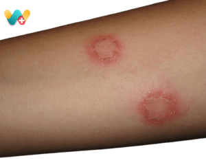Ringworm
