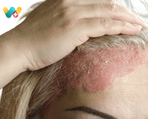 Scalp psoriasis