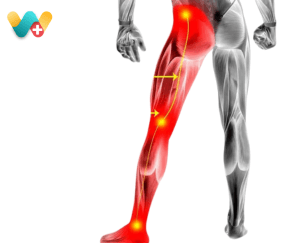 Sciatica