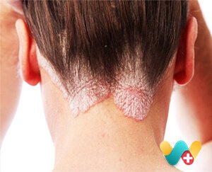 Skin Disorders