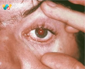 Trachoma