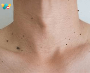 warts